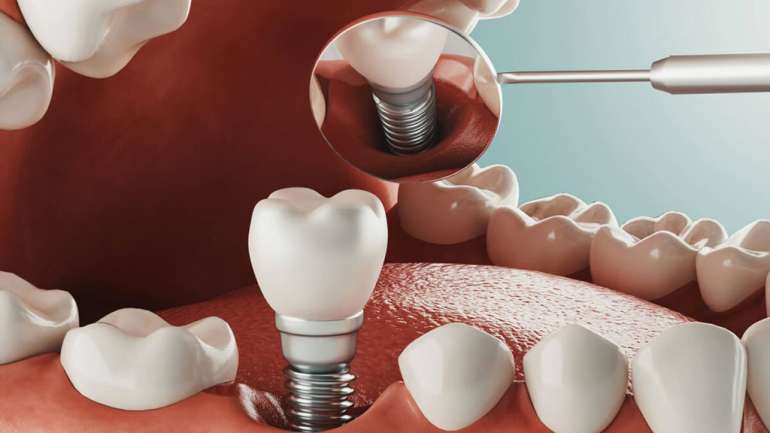 Understanding the World of Dental Implants in Melbourne