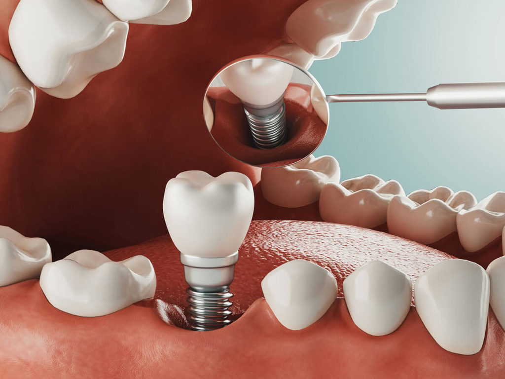 Understanding the World of Dental Implants in Melbourne